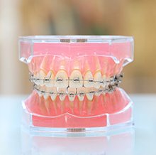 当院の小児矯正で使用する器具 イメージ4