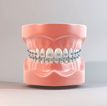 ワイヤー矯正（表側矯正） イメージ