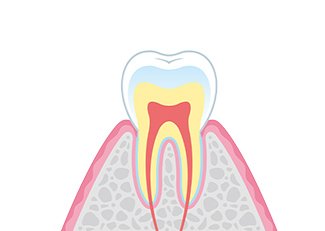 歯周病の進行 イメージ1